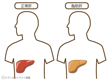 正常肝と脂肪肝のサムネイル画像